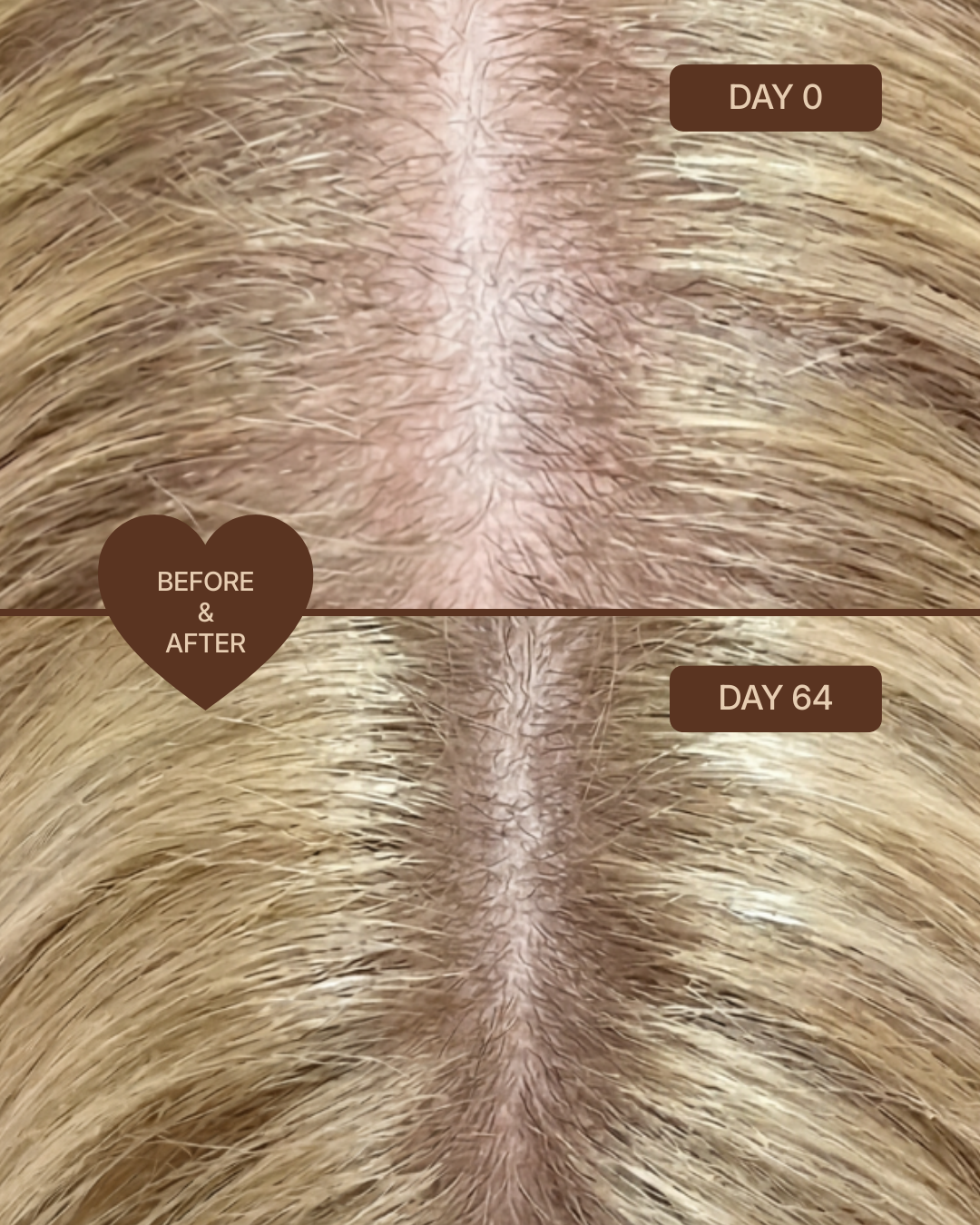 Hair Micro-Infusion System | Hyaluronic Acid 5%