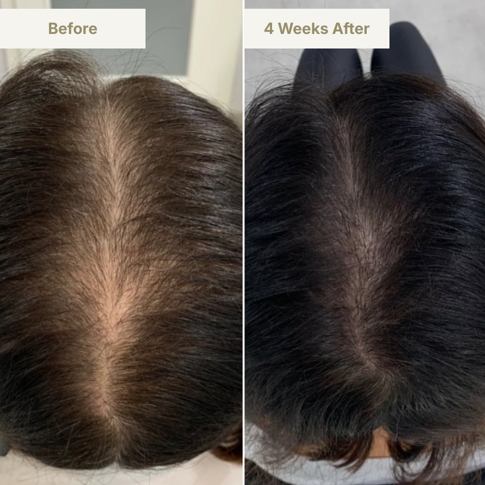 GENVEX™ Micro-Infusion System for Thicker, Healthier Hair