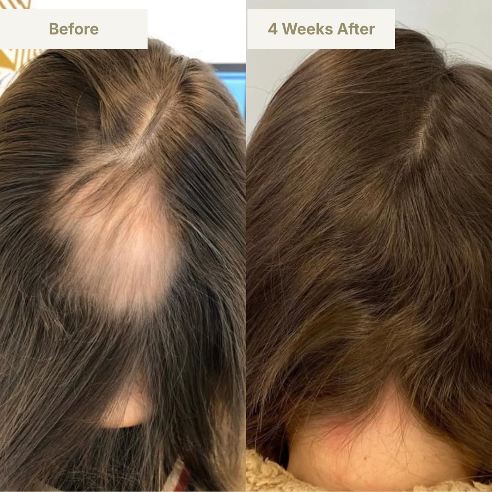 GENVEX™ Micro-Infusion System for Thicker, Healthier Hair