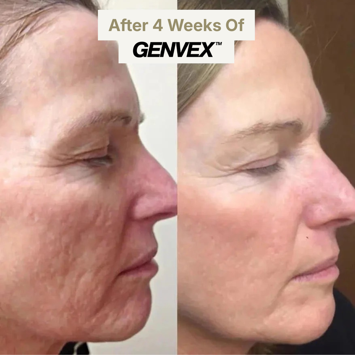 GENVEX™ Micro-Infusion System for Radiant, Youthful Skin